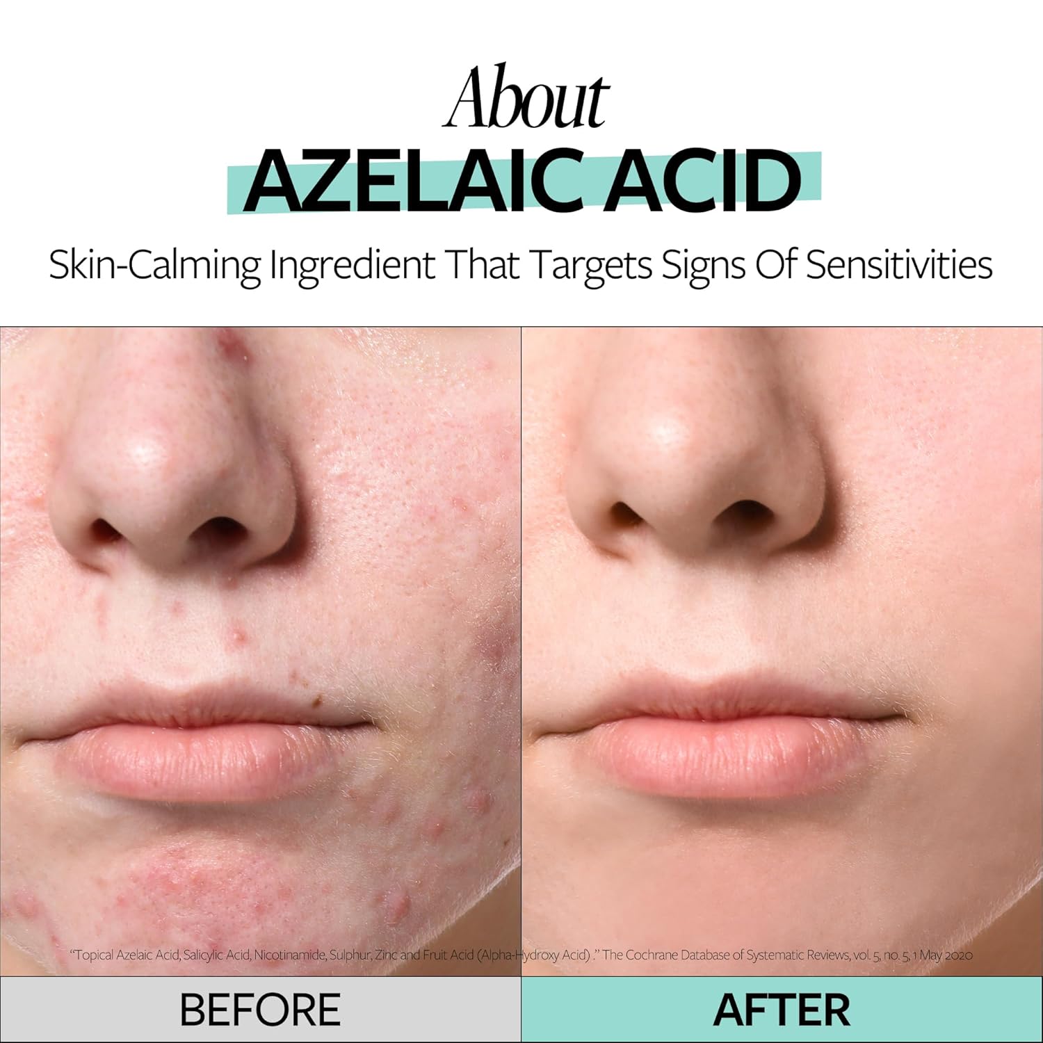 RECIPE Azelaic Acid 10 Soothing Ampoule - Soothing Serum, Facial Serum for Sensitive skin - Korean Skincare for Mild Breakouts (1.01 fl oz)